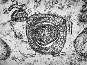 M,1y. | plexus papilloma